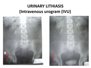 URINARY LITHIASIS
(Intravenous urogram (IVU)
 