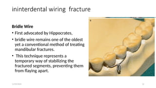 11/03/2024 12
ininterdental wiring fracture
Bridle Wire
• First advocated by Hippocrates,
• bridle wire remains one of the oldest
yet a conventional method of treating
mandibular fractures.
• This technique represents a
temporary way of stabilizing the
fractured segments, preventing them
from flaying apart.
 