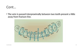 11/03/2024 17
Cont…
• The wire is passed interproximally between two teeth present a little
away from fracture line.
 