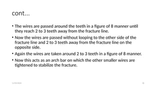 11/03/2024 18
cont...
• The wires are passed around the teeth in a figure of 8 manner until
they reach 2 to 3 teeth away from the fracture line.
• Now the wires are passed without looping to the other side of the
fracture line and 2 to 3 teeth away from the fracture line on the
opposite side.
• Again the wires are taken around 2 to 3 teeth in a figure of 8 manner.
• Now this acts as an arch bar on which the other smaller wires are
tightened to stabilize the fracture.
 