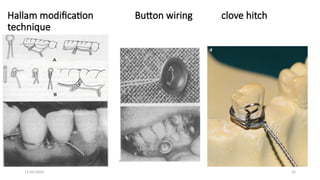 11/03/2024 24
Hallam modification Button wiring clove hitch
technique
 