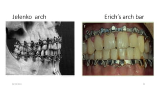 11/03/2024 33
Jelenko arch Erich’s arch bar
 