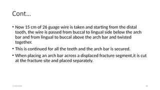 11/03/2024 36
Cont…
• Now 15 cm of 26 guage wire is taken and starting from the distal
tooth, the wire is passed from buccal to lingual side below the arch
bar and from lingual to buccal above the arch bar and twisted
together.
• This is continued for all the teeth and the arch bar is secured.
• When placing an arch bar across a displaced fracture segment,it is cut
at the fracture site and placed separately.
 