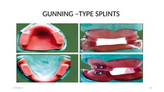 11/03/2024 38
GUNNING –TYPE SPLINTS
 