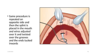 11/03/2024 42
• Same procedure is
repeated on
opposite side and
then the splint is
placed in the mouth
and wires adjusted
over it and twisted
over the grooves
and the ends tucked
inwards
 