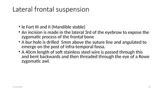 11/03/2024 49
Lateral frontal suspension
• le Fort III and II (Mandible stable)
• An incision is made in the lateral 3rd of the eyebrow to expose the
zygomatic process of the frontal bone
• A bur hole is drilled 5mm above the suture line and angulated to
emerge on the post of infra-temporal fossa.
• A 40cm length of soft stainless steel wire is passed through this
and bent backwards and then threaded through the eye of a Rowe
zygomatic awl.
 
