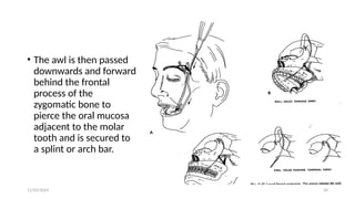 11/03/2024 50
• The awl is then passed
downwards and forward
behind the frontal
process of the
zygomatic bone to
pierce the oral mucosa
adjacent to the molar
tooth and is secured to
a splint or arch bar.
 