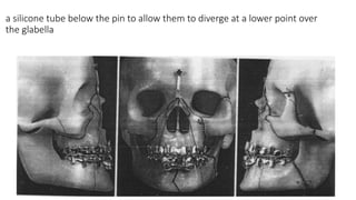 11/03/2024 52
a silicone tube below the pin to allow them to diverge at a lower point over
the glabella
 