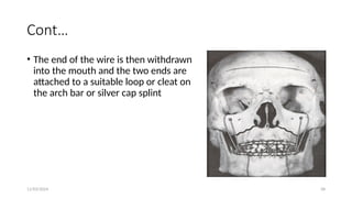 11/03/2024 58
Cont…
• The end of the wire is then withdrawn
into the mouth and the two ends are
attached to a suitable loop or cleat on
the arch bar or silver cap splint
 