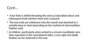 Cont…
• A bur hole is drilled threading the wires as described above and
subsequent fsoft stainless-steel wire is passed.
• The two ends are withdrawn into the mouth and attached to a
suitable loop or cleat depending on the method of intermaxillary
fixation used.
• In children, particularly when united to a circum mandibular wire
(also repeated on the contralateral side), a very rigid and stable
fixation can be achieved in this way
 