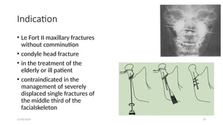 11/03/2024 67
Indication
• Le Fort II maxillary fractures
without comminution
• condyle head fracture
• in the treatment of the
elderly or ill patient
• contraindicated in the
management of severely
displaced single fractures of
the middle third of the
facialskeleton
 