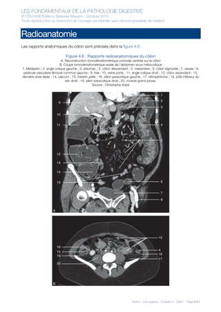 LES FONDAMENTAUX DE LA PATHOLOGIE DIGESTIVE
© CDU-HGE/Editions Elesevier-Masson - Octobre 2014
Toute reproduction ou traduction de l’ouvrage est interdite sans l’accord préalable de l’éditeur
Partie I : Les organes - Chapitre 4 : Côlon - Page 8/21
Radioanatomie
Les rapports anatomiques du côlon sont précisés dans la figure 4.6.
Figure 4.6 : Rapports radioanatomiques du côlon
A. Reconstruction tomodensitométrique coronale centrée sur le côlon
B. Coupe tomodensitométrique axiale de l’abdomen sous-mésocolique
1. Médiastin ; 2. angle colique gauche ; 3. estomac ; 4. côlon descendant ; 5. mésentère ; 6. côlon sigmoïde ; 7. vessie ; 8.
pédicule vasculaire fémoral commun gauche ; 9. foie ; 10. veine porte ; 11. angle colique droit ; 12. côlon ascendant ; 13.
dernière anse iléale ; 14. cæcum ; 15. intestin grêle ; 16. sillon paracolique gauche ; 17. rétropéritoine ; 18. pôle inférieur du
rein droit ; 19. sillon paracolique droit ; 20. muscle grand psoas.
Source : Christophe Aubé
9
10
11
12
13
14
15
18
15
4
16
17
12
19
20
B
8
7
6
5
4
3
2
1
A
 