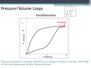 Pressure/Volume Loops
15 30
5
Overdistention
“beaking”
•Pressure continues to increase with little or no change in volume, creating a “bird beak”.
•Fix by reducing amount of tidal volume delivered
500
250
 