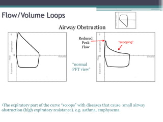 0 0
Reduced
Peak
Flow
“scooping”
Flow/Volume Loops
•The expiratory part of the curve “scoops” with diseases that cause small airway
obstruction (high expiratory resistance). e.g. asthma, emphysema.
Airway Obstruction
“normal
PFT view”
 