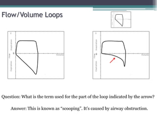 0 0
Flow/Volume Loops
Question: What is the term used for the part of the loop indicated by the arrow?
Answer: This is known as “scooping”. It’s caused by airway obstruction.
 