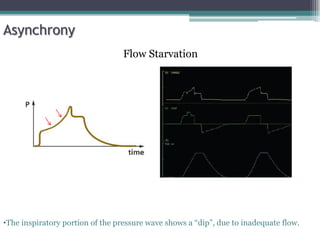 Asynchrony
Flow Starvation
•The inspiratory portion of the pressure wave shows a “dip”, due to inadequate flow.
 