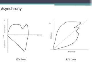 Asynchrony
F/V Loop P/V Loop
 