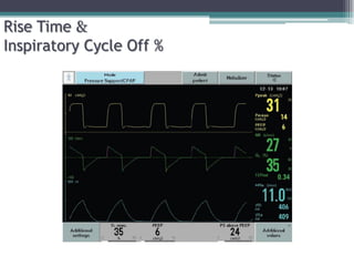 Rise Time &
Inspiratory Cycle Off %
 