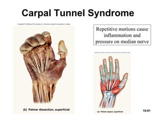 10-61
Carpal Tunnel Syndrome
Repetitive motions cause
inflammation and
pressure on median nerve
 