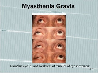 11-111
Myasthenia Gravis
Drooping eyelids and weakness of muscles of eye movement
 