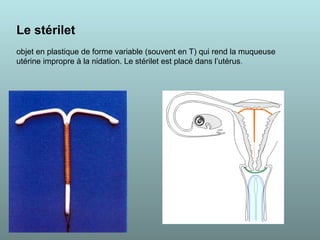 Le stérilet
objet en plastique de forme variable (souvent en T) qui rend la muqueuse
utérine impropre à la nidation. Le stérilet est placé dans l’utérus.
 