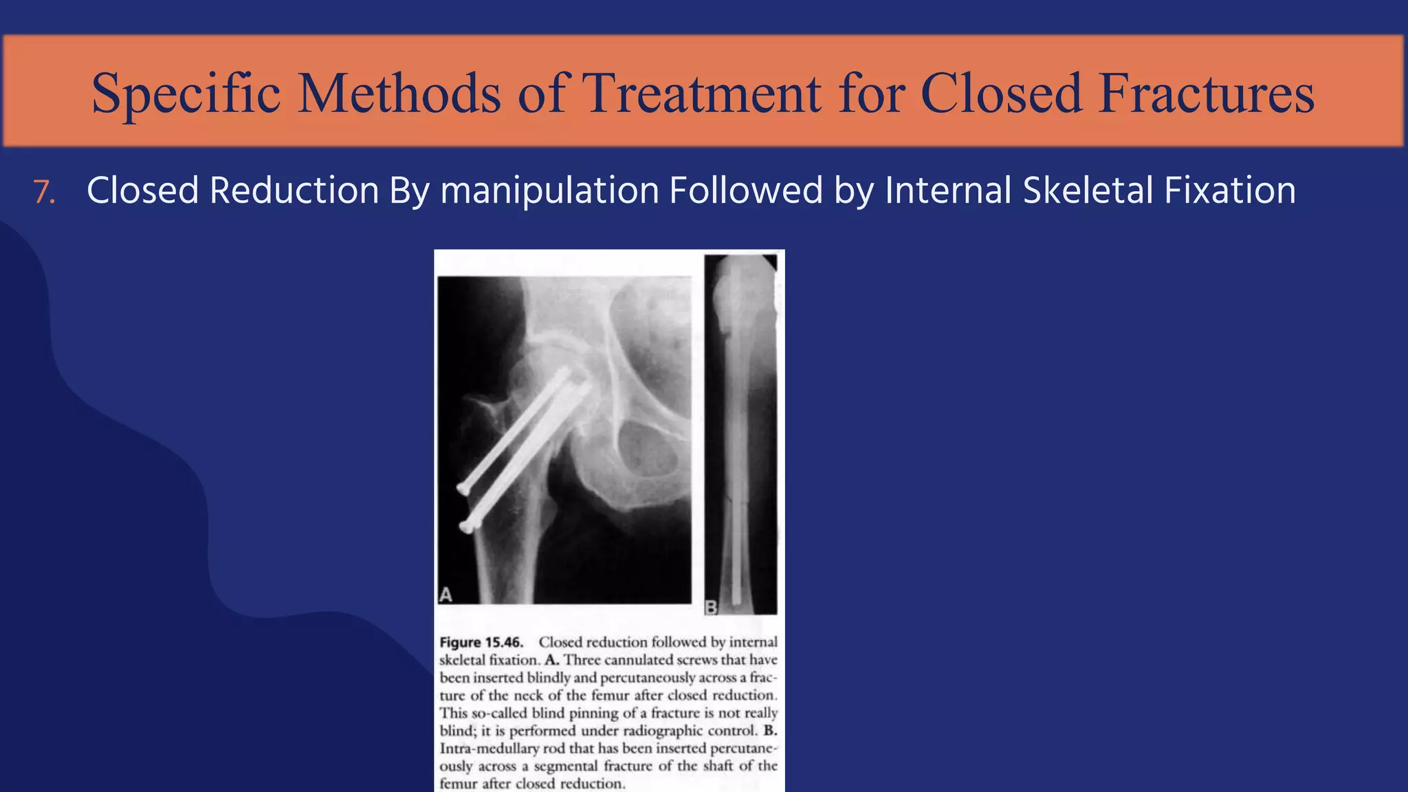 Specific Methods of Treatment for Closed Fractures
7. Closed Reduction By manipulation Followed by Internal Skeletal Fixation
 