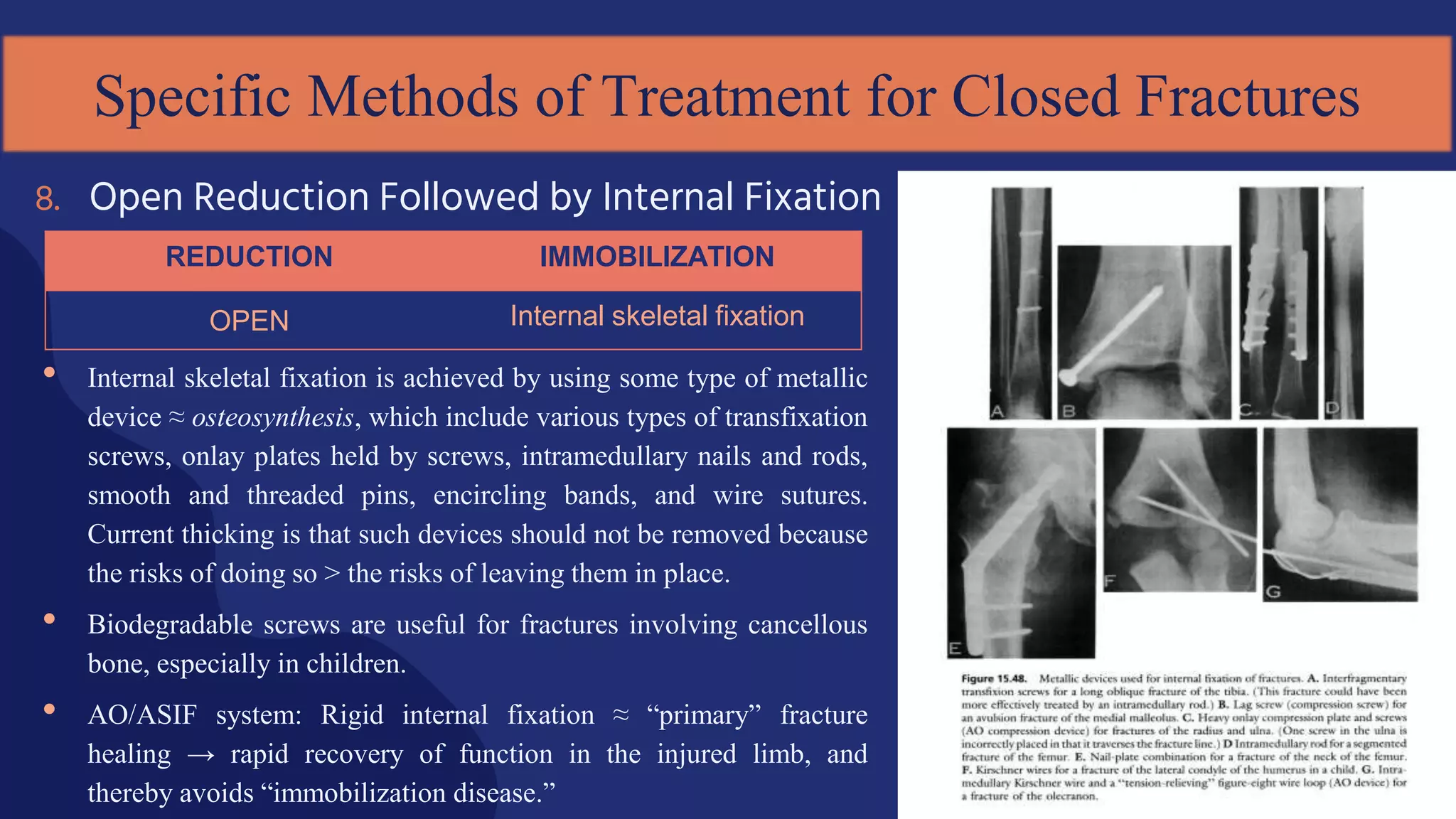 • Internal skeletal fixation is achieved by using some type of metallic
device ≈ osteosynthesis, which include various types of transfixation
screws, onlay plates held by screws, intramedullary nails and rods,
smooth and threaded pins, encircling bands, and wire sutures.
Current thicking is that such devices should not be removed because
the risks of doing so > the risks of leaving them in place.
• Biodegradable screws are useful for fractures involving cancellous
bone, especially in children.
• AO/ASIF system: Rigid internal fixation ≈ “primary” fracture
healing → rapid recovery of function in the injured limb, and
thereby avoids “immobilization disease.”
8. Open Reduction Followed by Internal Fixation
Specific Methods of Treatment for Closed Fractures
REDUCTION IMMOBILIZATION
OPEN Internal skeletal fixation
 