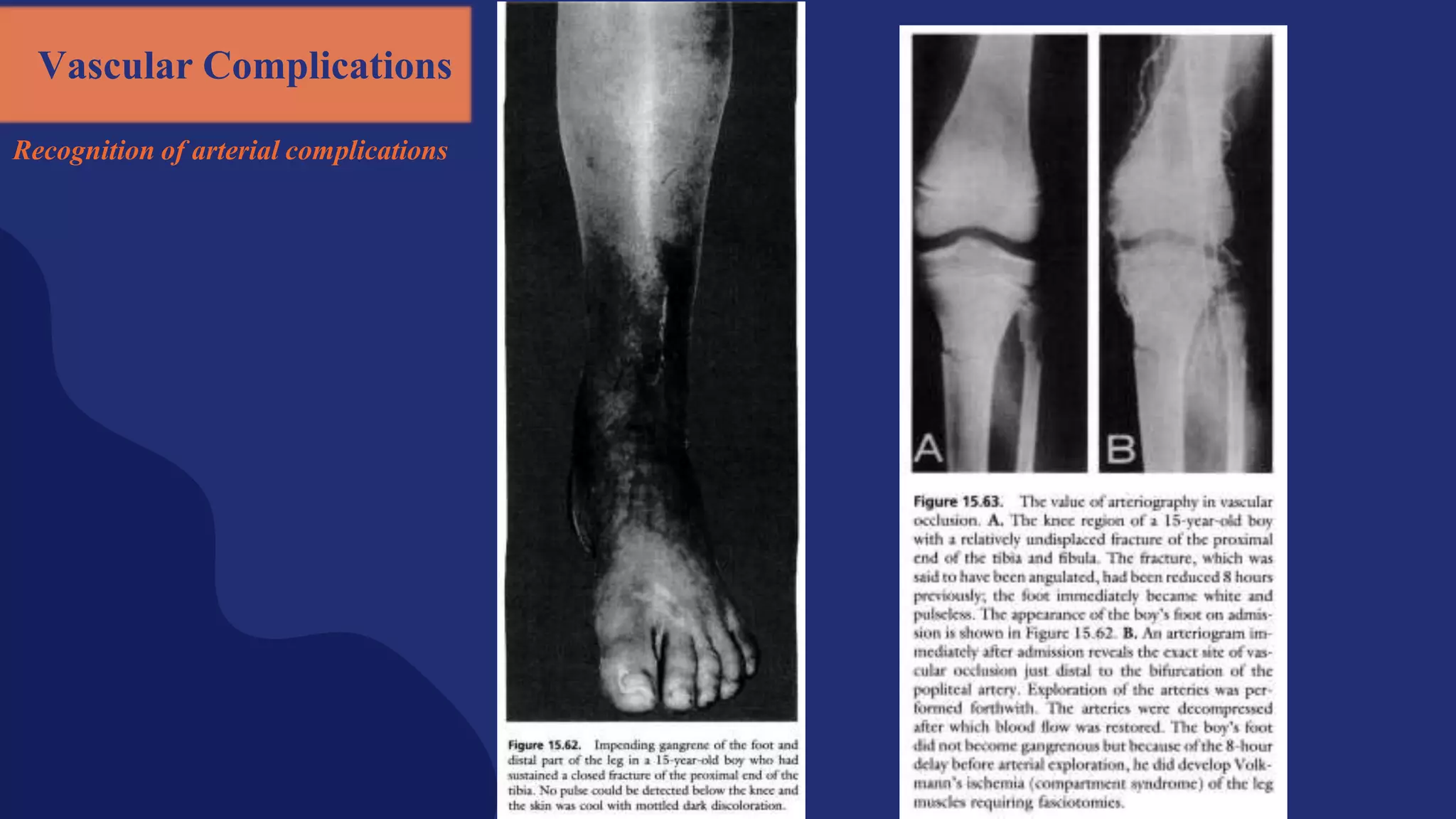 Vascular Complications
Recognition of arterial complications
 