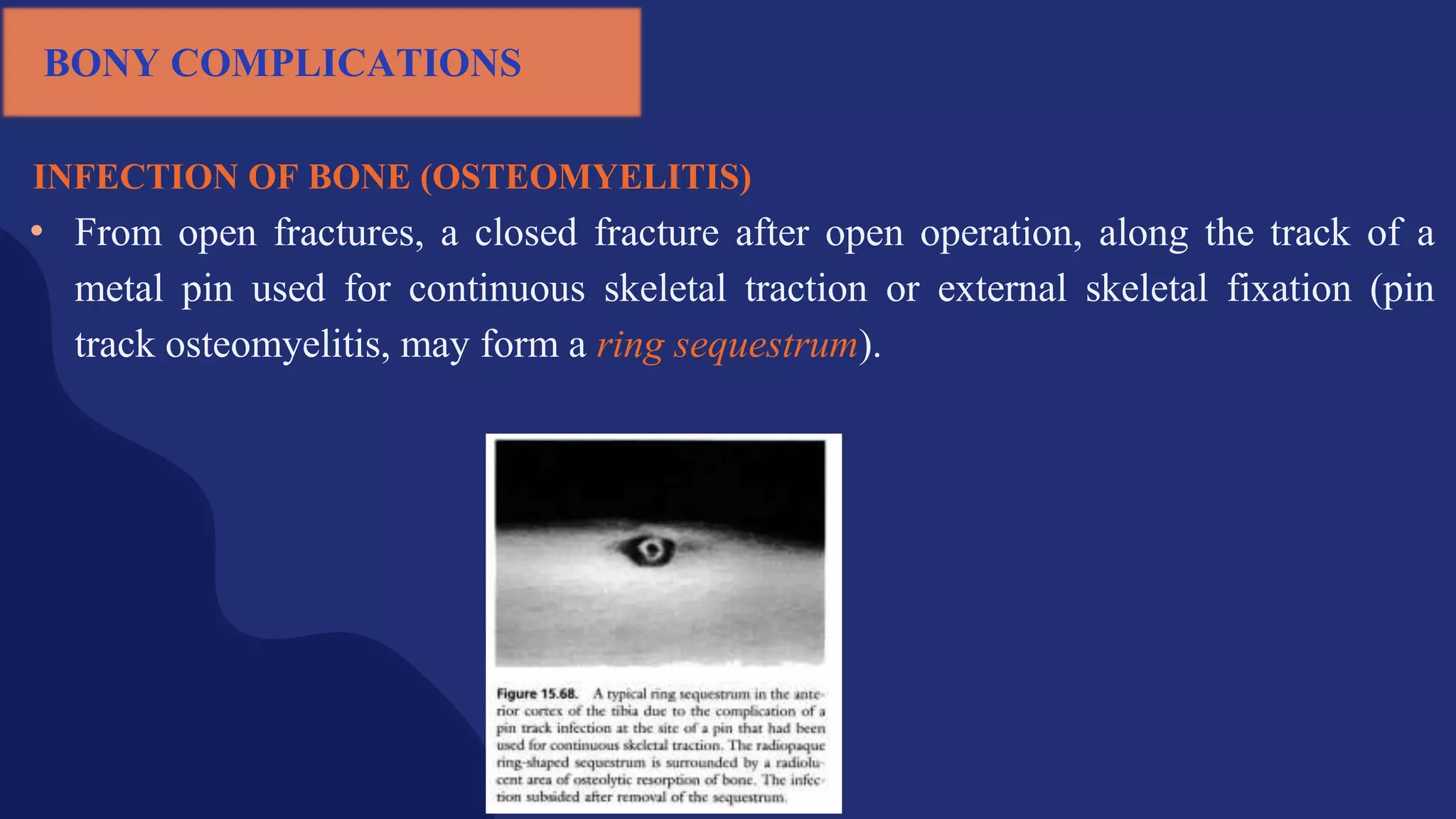 INFECTION OF BONE (OSTEOMYELITIS)
• From open fractures, a closed fracture after open operation, along the track of a
metal pin used for continuous skeletal traction or external skeletal fixation (pin
track osteomyelitis, may form a ring sequestrum).
BONY COMPLICATIONS
 