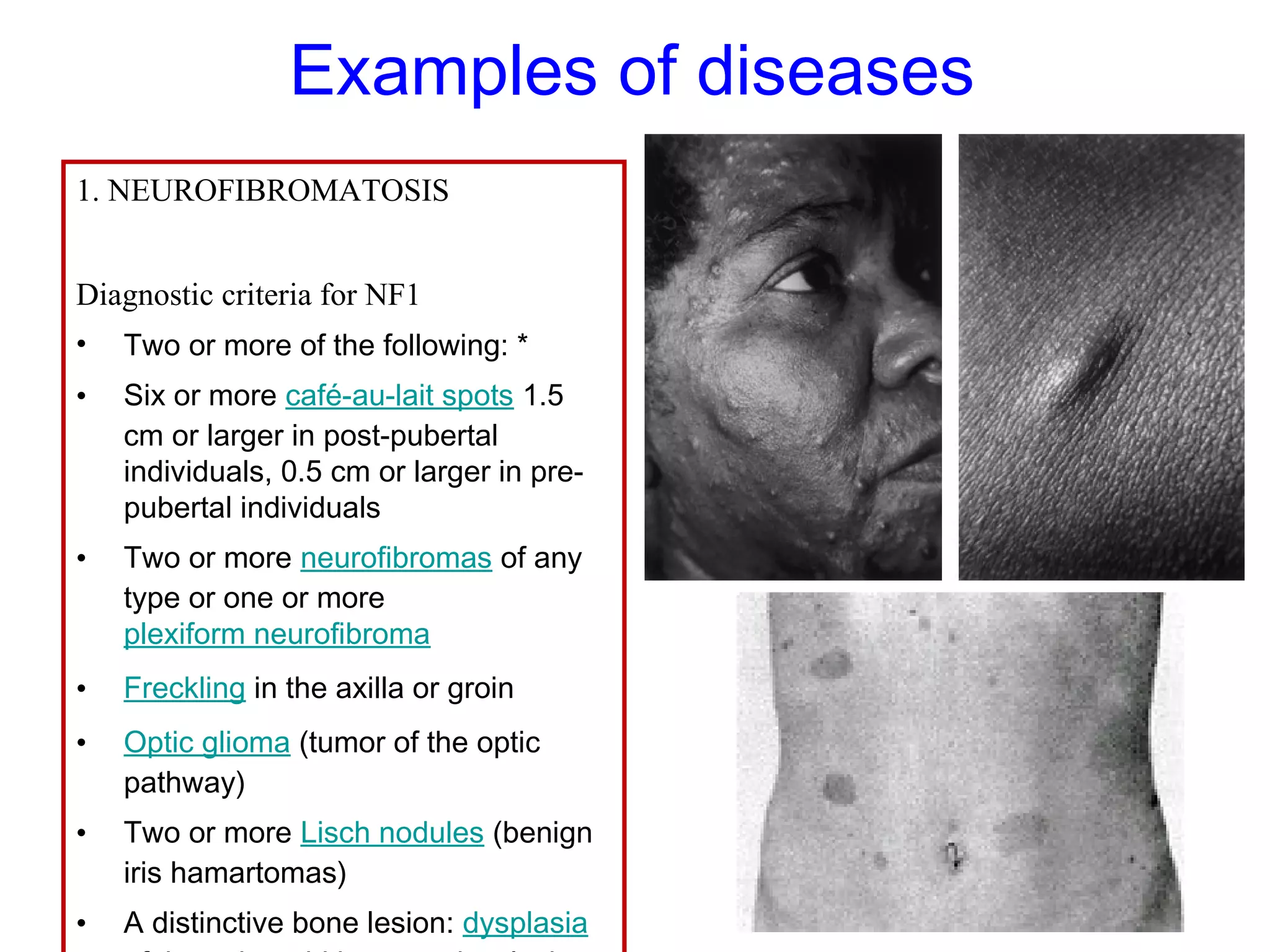 Examples of diseases
1. NEUROFIBROMATOSIS
Diagnostic criteria for NF1
• Two or more of the following: *
• Six or more café-au-lait spots 1.5
cm or larger in post-pubertal
individuals, 0.5 cm or larger in pre-
pubertal individuals
• Two or more neurofibromas of any
type or one or more
plexiform neurofibroma
• Freckling in the axilla or groin
• Optic glioma (tumor of the optic
pathway)
• Two or more Lisch nodules (benign
iris hamartomas)
• A distinctive bone lesion: dysplasia
 