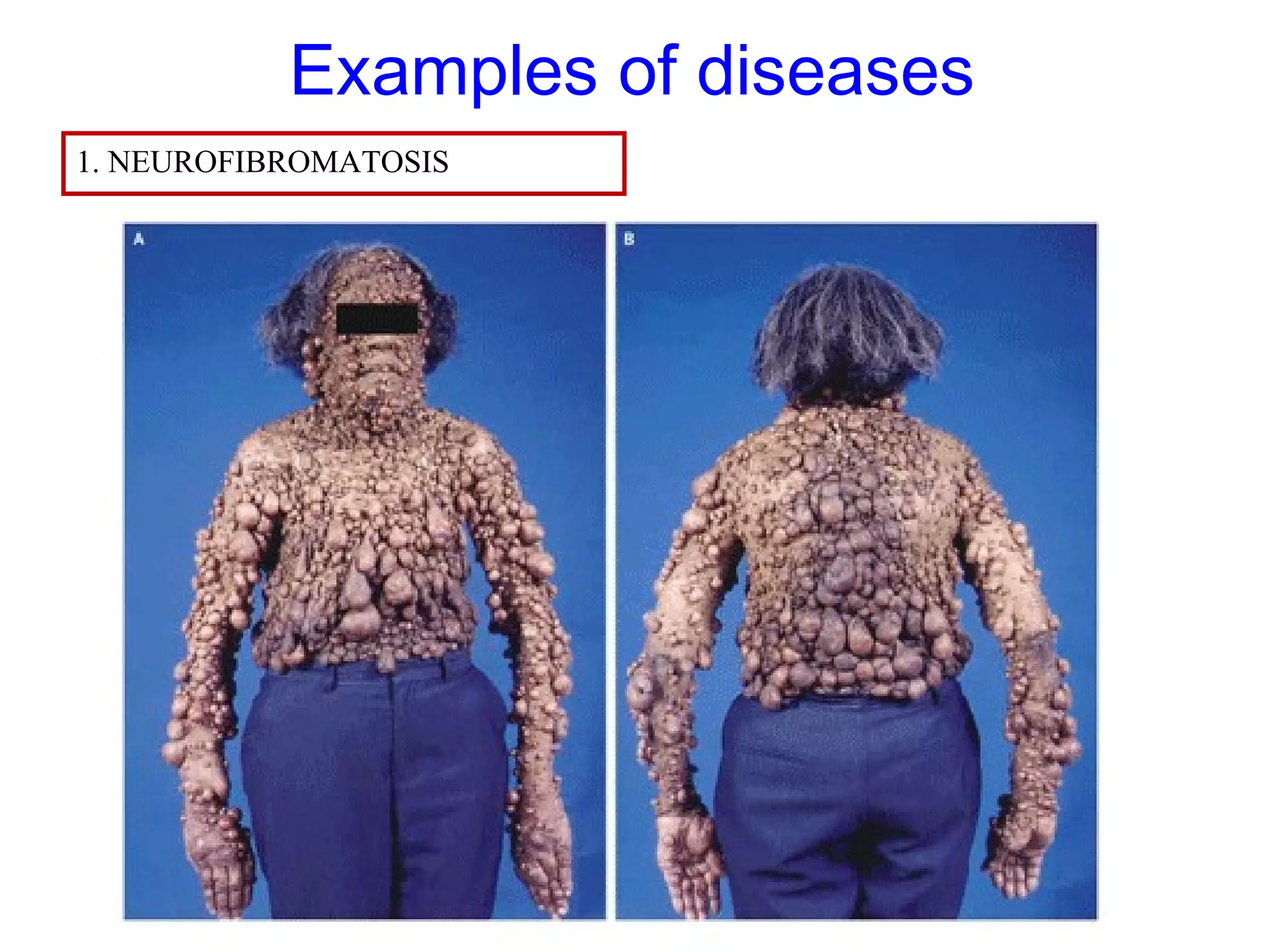 Examples of diseases
1. NEUROFIBROMATOSIS
 