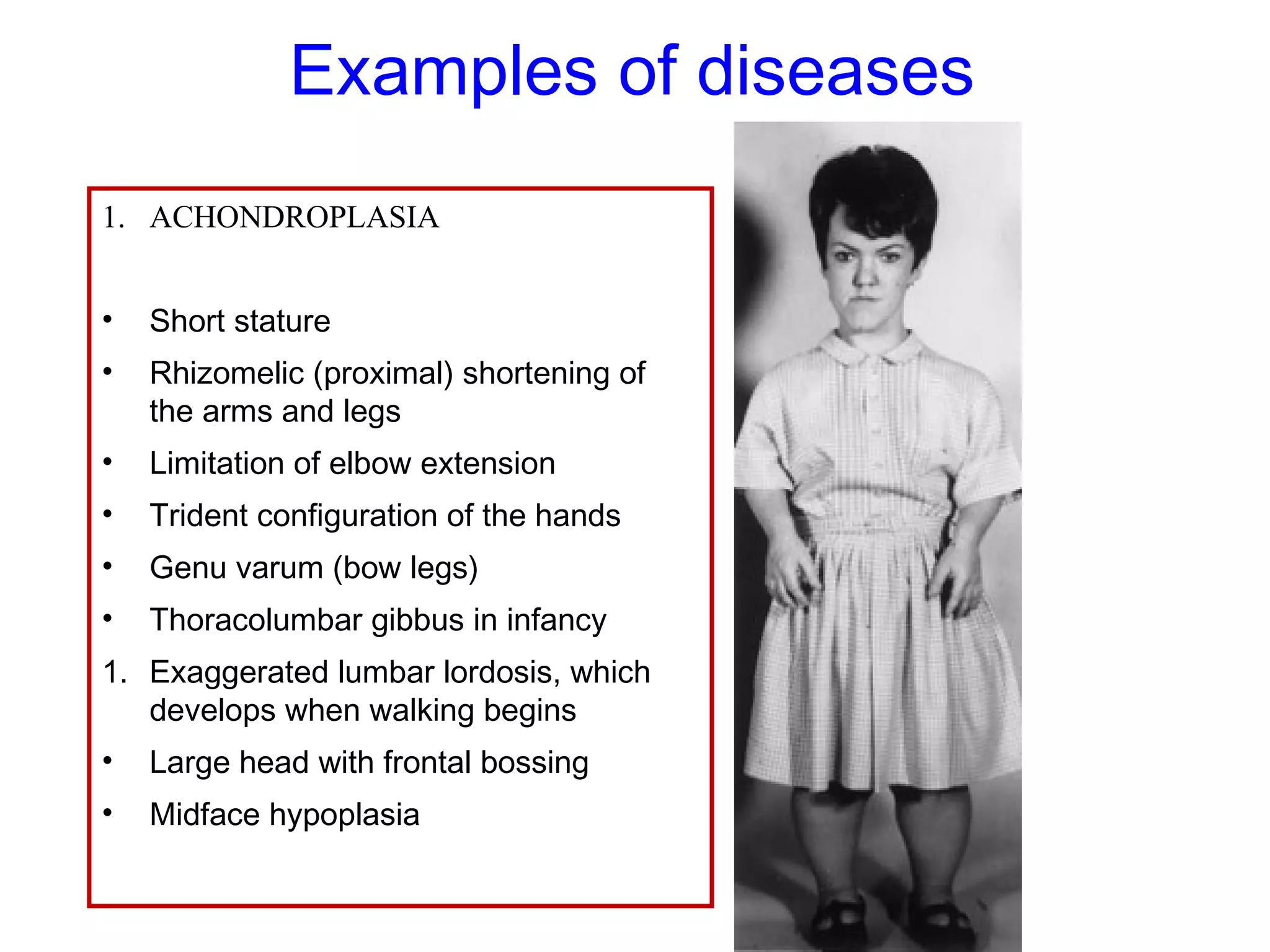 Examples of diseases
1. ACHONDROPLASIA
• Short stature
• Rhizomelic (proximal) shortening of
the arms and legs
• Limitation of elbow extension
• Trident configuration of the hands
• Genu varum (bow legs)
• Thoracolumbar gibbus in infancy
1. Exaggerated lumbar lordosis, which
develops when walking begins
• Large head with frontal bossing
• Midface hypoplasia
 