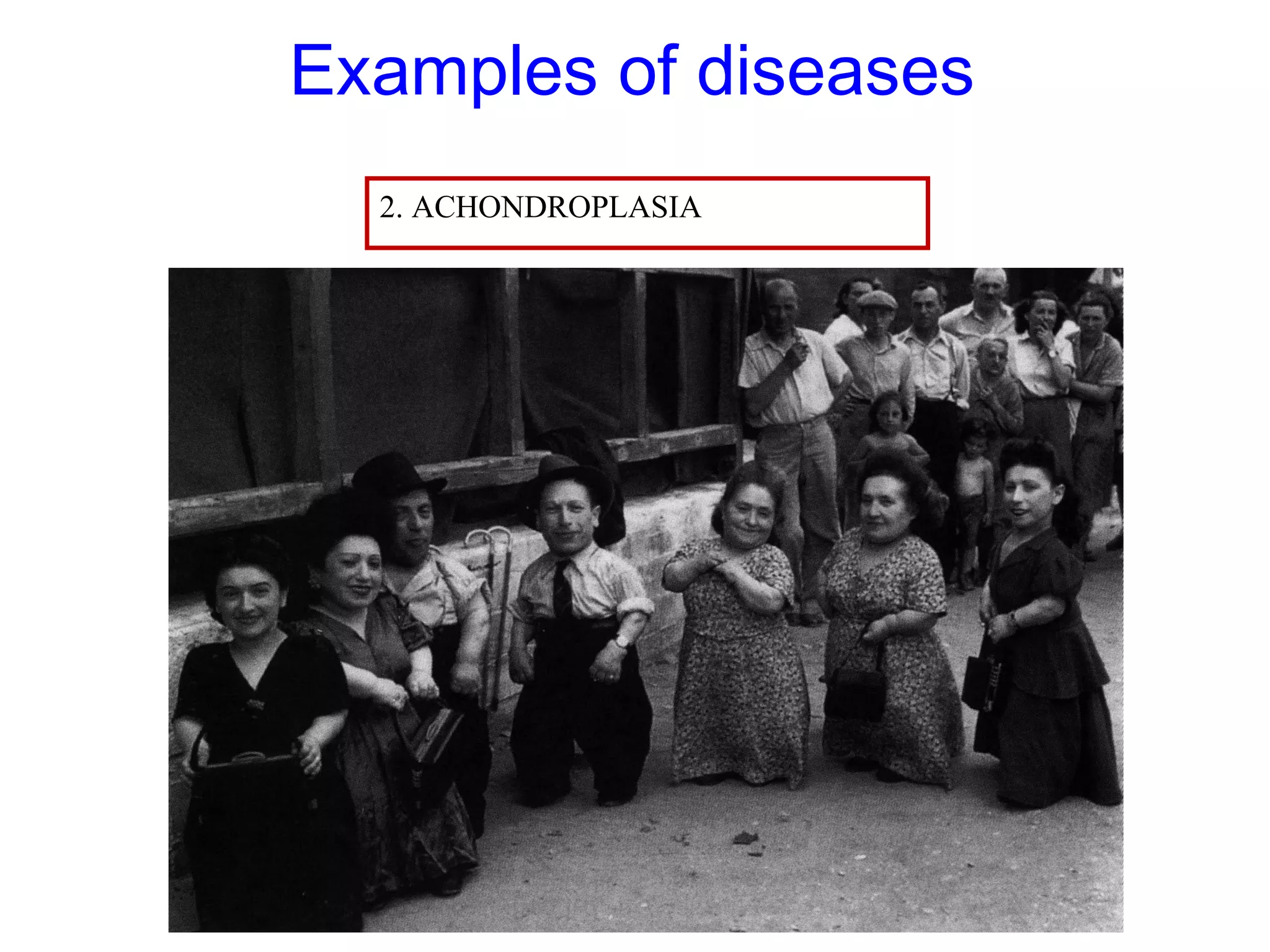 Examples of diseases
2. ACHONDROPLASIA
 