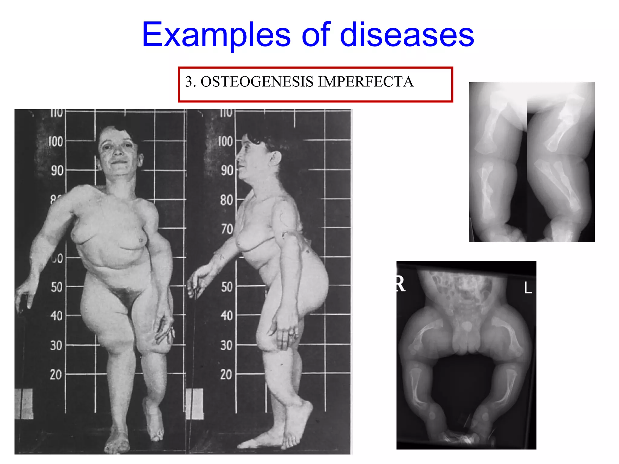 Examples of diseases
3. OSTEOGENESIS IMPERFECTA
 