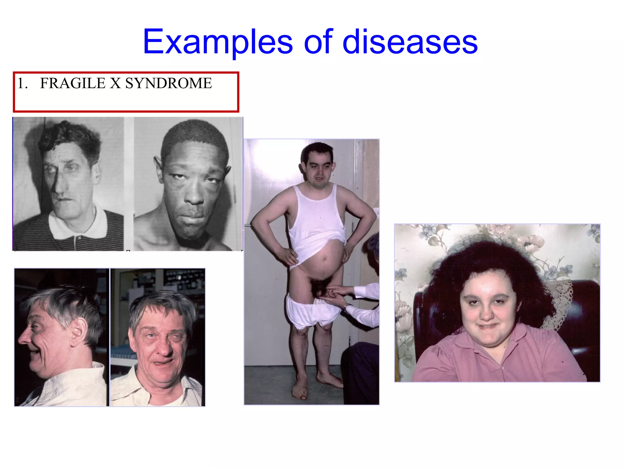 Examples of diseases
1. FRAGILE X SYNDROME
 
