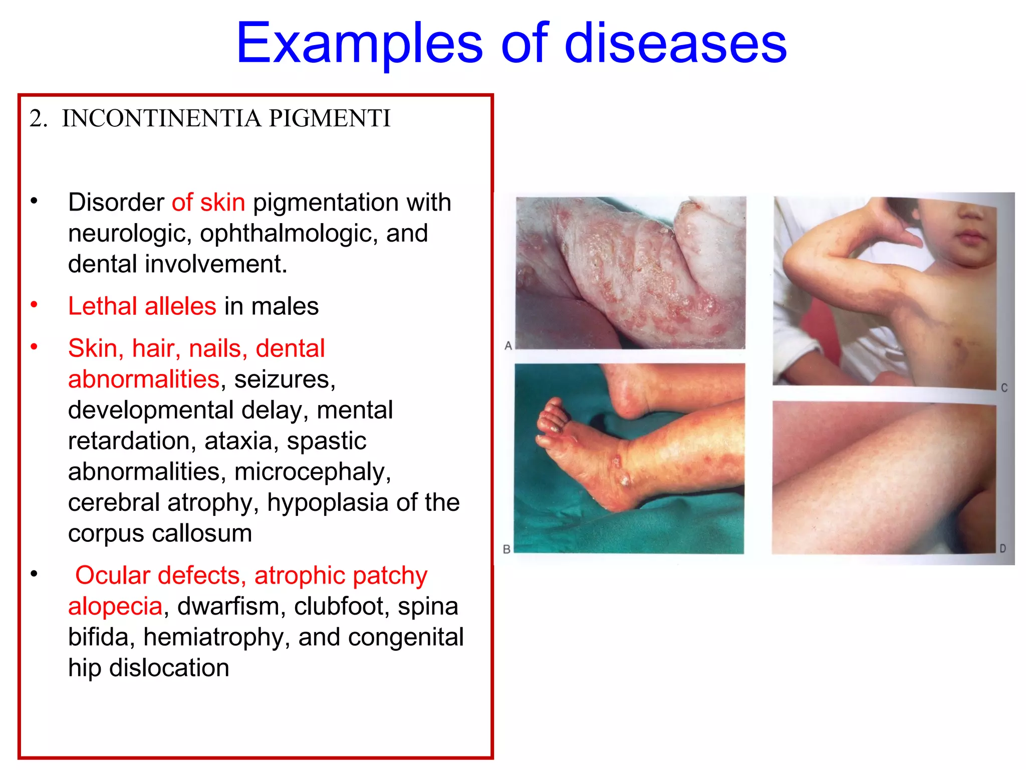 Examples of diseases
2. INCONTINENTIA PIGMENTI
• Disorder of skin pigmentation with
neurologic, ophthalmologic, and
dental involvement.
• Lethal alleles in males
• Skin, hair, nails, dental
abnormalities, seizures,
developmental delay, mental
retardation, ataxia, spastic
abnormalities, microcephaly,
cerebral atrophy, hypoplasia of the
corpus callosum
• Ocular defects, atrophic patchy
alopecia, dwarfism, clubfoot, spina
bifida, hemiatrophy, and congenital
hip dislocation
 
