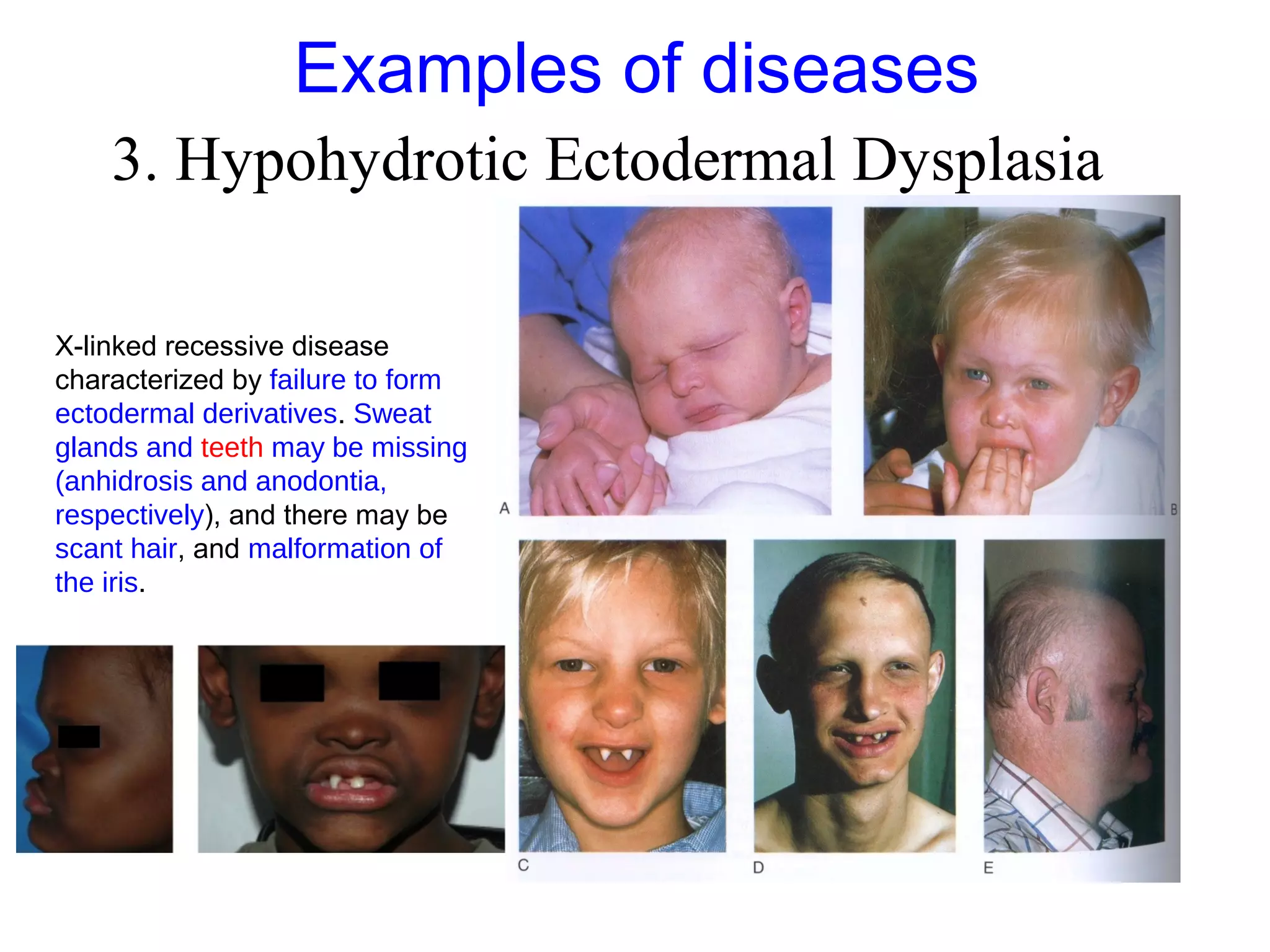 Examples of diseases
3. Hypohydrotic Ectodermal Dysplasia
X-linked recessive disease
characterized by failure to form
ectodermal derivatives. Sweat
glands and teeth may be missing
(anhidrosis and anodontia,
respectively), and there may be
scant hair, and malformation of
the iris.
 