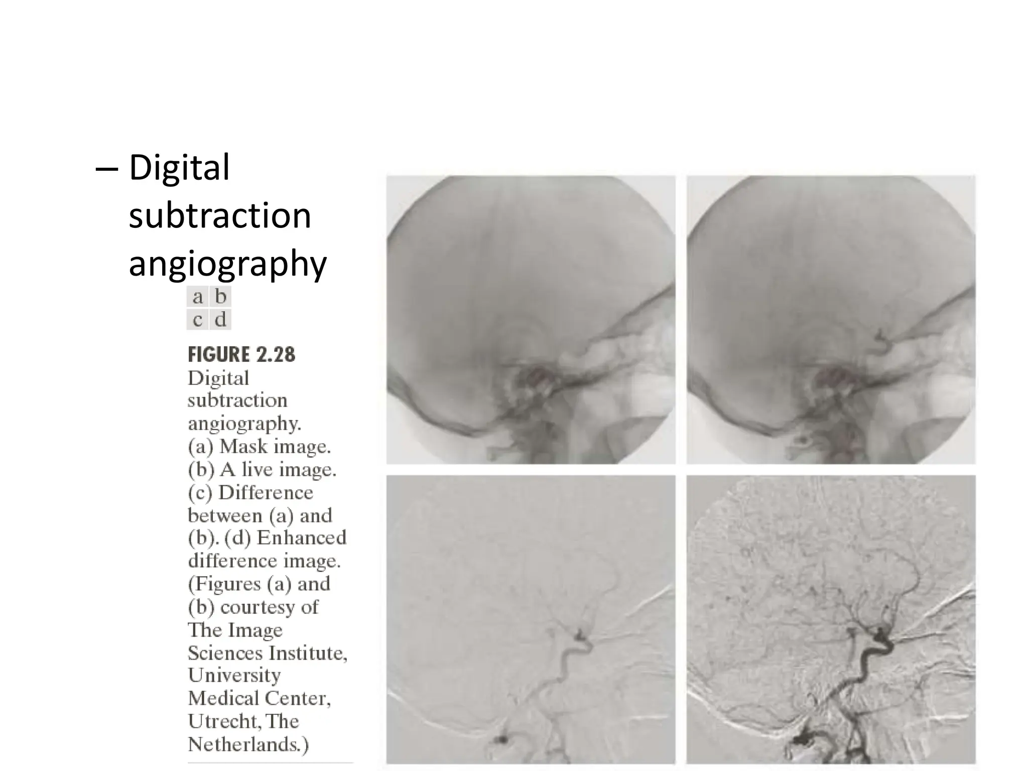 – Digital subtraction angiography 