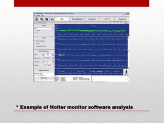 * Example of Holter monitor software analysis
