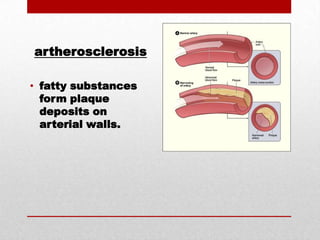 artherosclerosisfatty substances form plaque deposits on arterial walls.