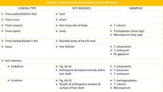 CLINICAL CLASSIFICATION DEPENDING ON SITE INVOLVED
CLINICAL TYPE SITE INVOLVED EXAMPLES
 Tinea pedis/athlete’s foot  Foot
 Tinea cruris  Groin
 Tinea corporis  Non-hairy skin of body  T. rubrum
 Tinea capitis  Scalp  Trichophyton (most spp)
 Microsporum (any spp)
 Tinea barbae/barber’s itch  Bearded areas of face & neck
 Favus  Hair follicles  T. schoenleinii
 T. violaceum
 M. gypseum
 Hair infection
 Endothrix  Fig. 66.10
 Arthospore formation entirely within
hair shaft
 T. schoenleinii
 T. tonsurans
 T. violaceum
 Ectothrix  Fig. 66.10
 Sheath of arthospores present on
surface of hair shaft
 T. mentagrophytes
 T. rubrum
 Microsporum
 