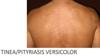 TINEA/PITYRIASIS VERSICOLOR
 