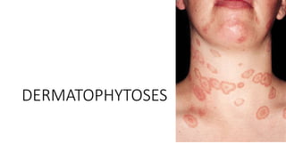 DERMATOPHYTOSES
 