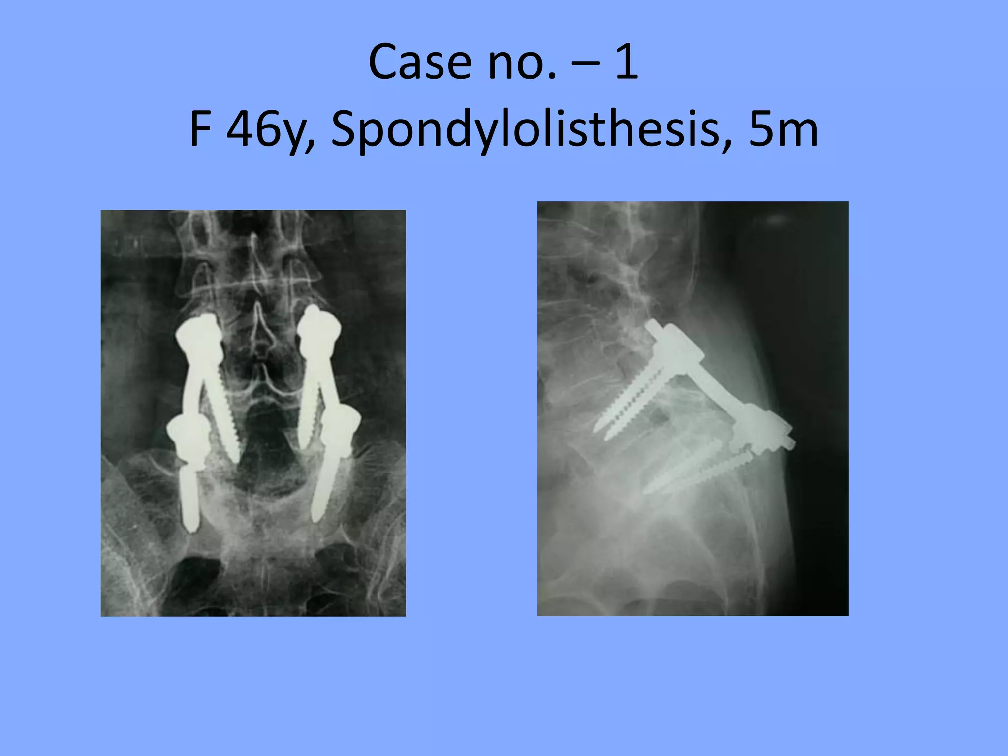 Case no. – 1
F 46y, Spondylolisthesis, 5m
 