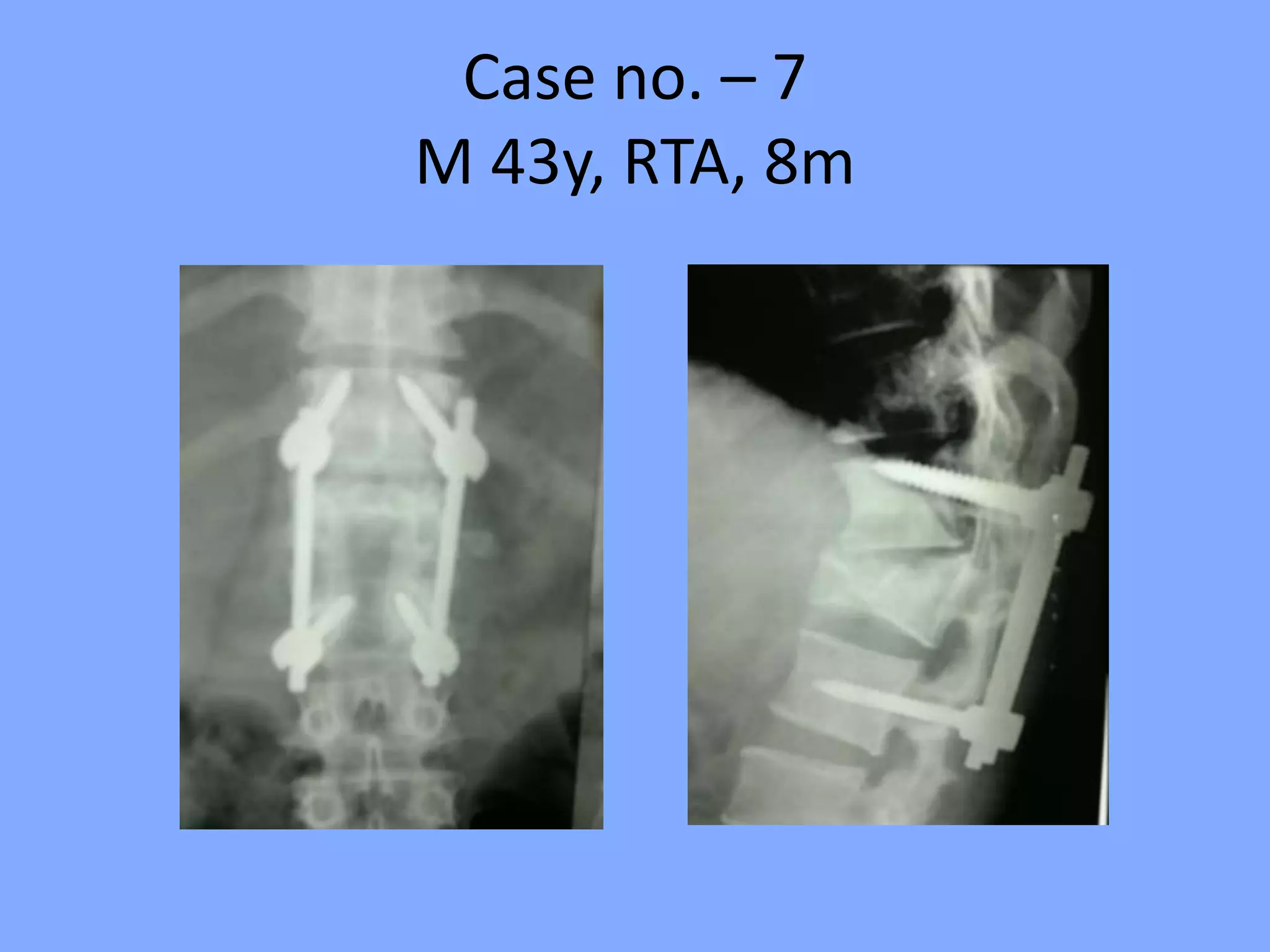 Case no. – 7
M 43y, RTA, 8m
 