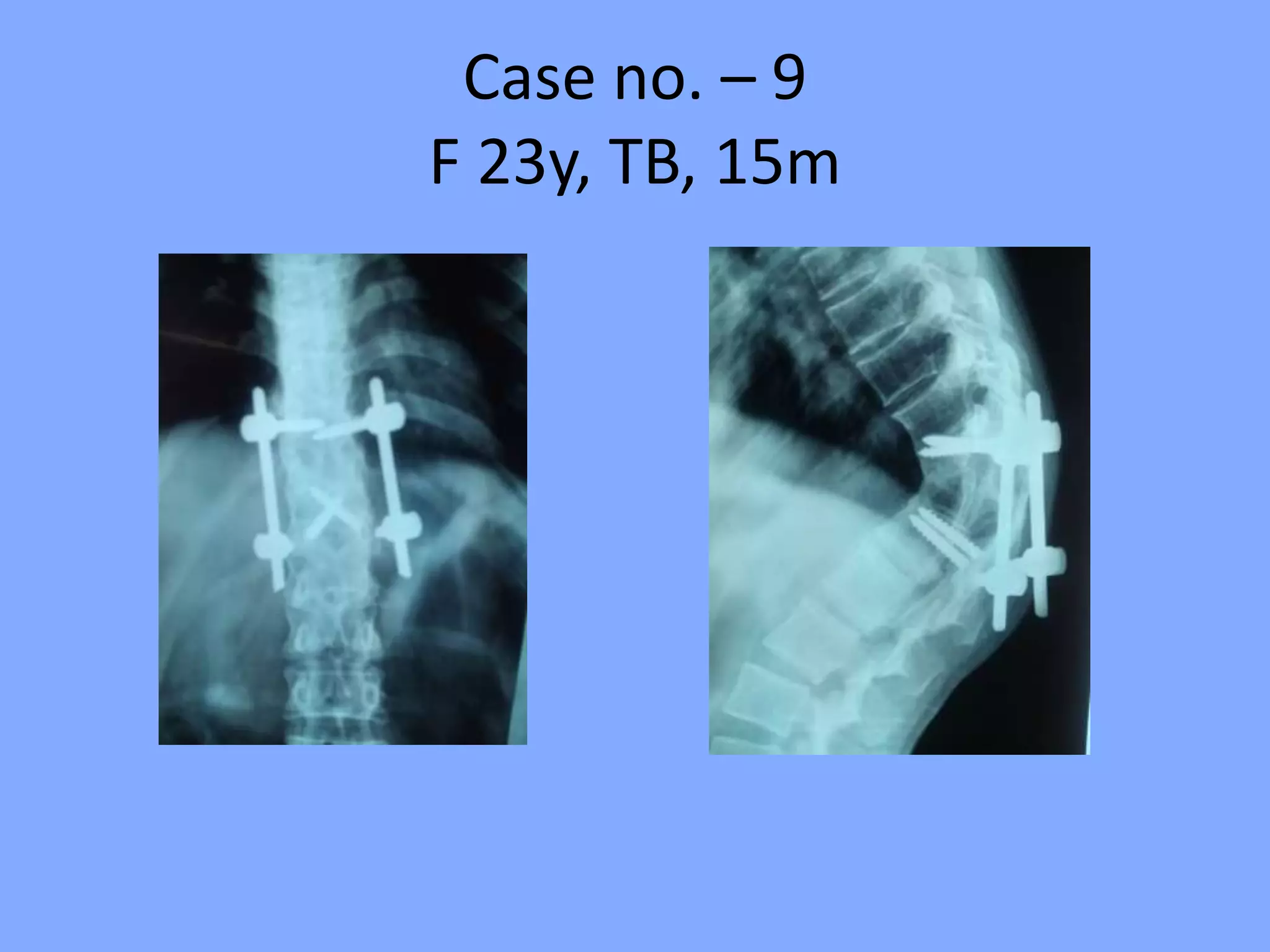 Case no. – 9
F 23y, TB, 15m
 