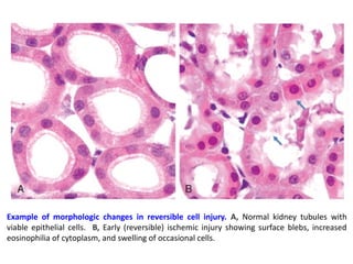 Comprehensive Overview of Reversible Cell Injury in Pathophysiology | PPTX