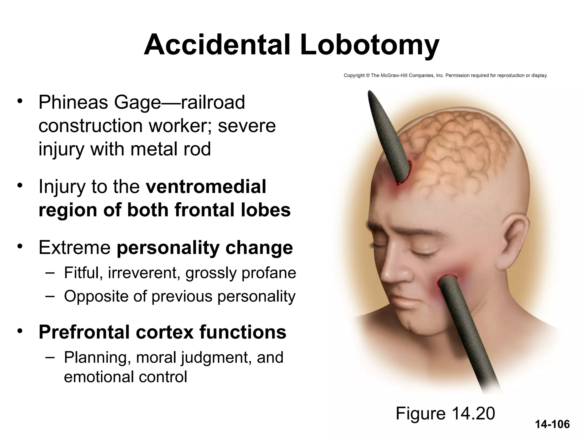 14-106
Accidental Lobotomy
• Phineas Gage—railroad
construction worker; severe
injury with metal rod
• Injury to the ventromedial
region of both frontal lobes
• Extreme personality change
– Fitful, irreverent, grossly profane
– Opposite of previous personality
• Prefrontal cortex functions
– Planning, moral judgment, and
emotional control
Figure 14.20
 