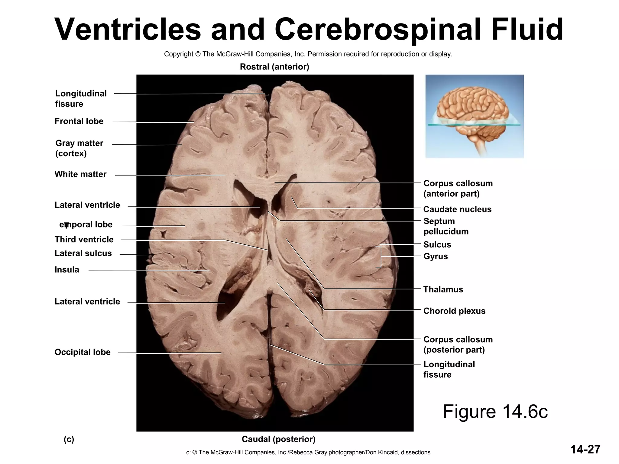 Choroid plexus
Thalamus
Gyrus
Sulcus
Caudate nucleus
Frontal lobe
White matter
Lateral ventricle
Temporal lobe
Third ventricle
Lateral sulcus
Insula
Lateral ventricle
Occipital lobe
(c)
Rostral (anterior)
Caudal (posterior)
Corpus callosum
(anterior part)
Septum
pellucidum
Corpus callosum
(posterior part)
Longitudinal
fissure
Gray matter
(cortex)
Longitudinal
fissure
14-27
Ventricles and Cerebrospinal Fluid
Figure 14.6c
Copyright © The McGraw-Hill Companies, Inc. Permission required for reproduction or display.
c: © The McGraw-Hill Companies, Inc./Rebecca Gray,photographer/Don Kincaid, dissections
 