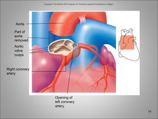 Copyright © The McGraw-Hill Companies, Inc. Permission required for reproduction or display. Aorta Part of aorta removed Aortic valve cusps Right coronary artery Opening of left coronary artery 